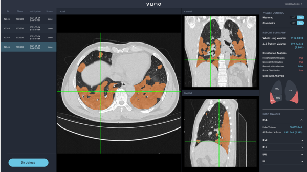 뷰노메드 렁퀀트는 인공지능을 기반으로 폐 CT 영상을 자동으로 분석해 CT 영상에서 특징적인 영역을 분할하고, 세부 영역별 시각화 및 정량화 정보를 제공하는 솔루션이다.
