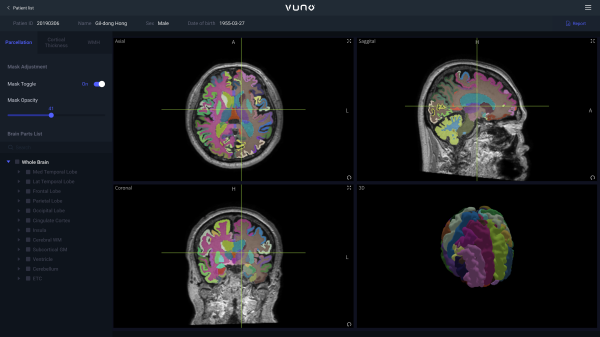 뷰노메드 딥브레인은 딥러닝을 기반으로 뇌 MRI 영상을 분석해 뇌 영역을 100여개 이상으로 분할하고 각 영역의 위축정도를 정량화한 정보를 1분 내 제공하는 인공지능 의료기기다.