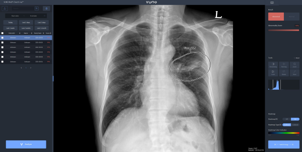뷰노메드 체스트 엑스레이는 흉부 엑스레이 영상에서 주요 이상소견을 높은 정확도로 탐지하고, 이상소견의 소견명과 위치를 제시해 결핵, 폐렴 등 주요 폐 질환 진단을 돕는 인공지능 솔루션이다.